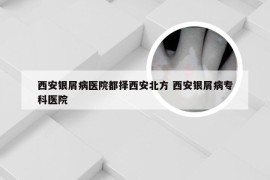西安银屑病医院都择西安北方 西安银屑病专科医院