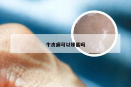 牛皮癣可以蜂蜜吗