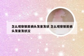 怎么观察银屑病头发束发状 怎么观察银屑病头发束发状况