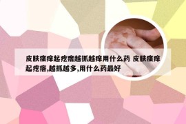 皮肤瘙痒起疙瘩越抓越痒用什么药 皮肤瘙痒起疙瘩,越抓越多,用什么药最好