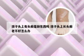 孩子头上有头癣是缺东西吗 孩子头上长头癣老不好怎么办