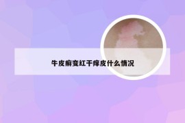 牛皮癣变红干痒皮什么情况
