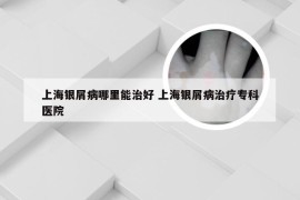 上海银屑病哪里能治好 上海银屑病治疗专科医院