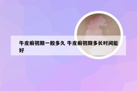 牛皮癣初期一般多久 牛皮癣初期多长时间能好