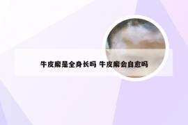 牛皮廨是全身长吗 牛皮廨会自愈吗