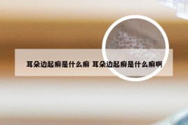 耳朵边起癣是什么癣 耳朵边起癣是什么癣啊
