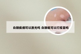 白颠疯病可以激光吗 白颠疯可以打疫苗吗