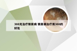 308光治疗银屑病 银屑病治疗用308的好处
