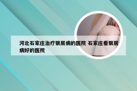 河北石家庄治疗银屑病的医院 石家庄看银屑病好的医院