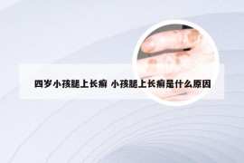四岁小孩腿上长癣 小孩腿上长癣是什么原因