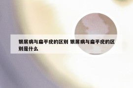 银屑病与扁平疣的区别 银屑病与扁平疣的区别是什么