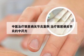 中医治疗银屑病关节炎案例 治疗银屑病关节炎的中药方