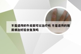 不是遗传的牛皮藓可以治疗吗 不是遗传的银屑病治好后会复发吗