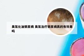 臭氧化油银屑病 臭氧治疗银屑病真的有效果吗