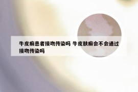 牛皮癣患者接吻传染吗 牛皮肤癣会不会通过接吻传染吗