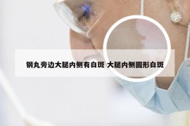 钢丸旁边大腿内侧有白斑 大腿内侧圆形白斑