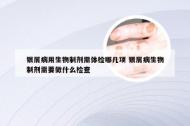 银屑病用生物制剂需体检哪几项 银屑病生物制剂需要做什么检查
