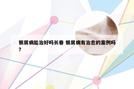 银屑病能治好吗长春 银屑病有治愈的案例吗?