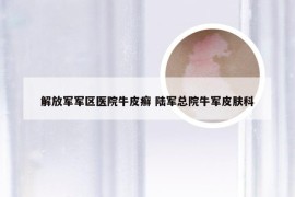 解放军军区医院牛皮癣 陆军总院牛军皮肤科