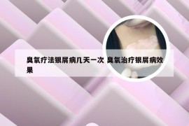 臭氧疗法银屑病几天一次 臭氧治疗银屑病效果