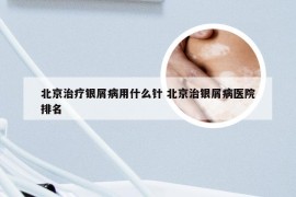 北京治疗银屑病用什么针 北京治银屑病医院排名