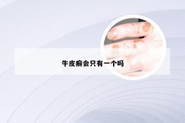 牛皮癣会只有一个吗