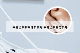 手臂上长癣用什么药好 手臂上长藓怎么办