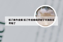 肛门有牛皮癣 肛门牛皮癣抹药好了不抹药又开始了