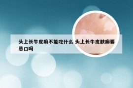 头上长牛皮癣不能吃什么 头上长牛皮肤癣要忌口吗