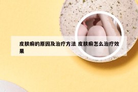 皮肤癣的原因及治疗方法 皮肤癣怎么治疗效果