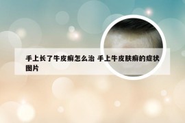 手上长了牛皮癣怎么治 手上牛皮肤癣的症状图片