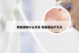 银翘病抹什么药膏 银翘病治疗方法