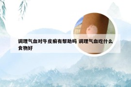 调理气血对牛皮癣有帮助吗 调理气血吃什么食物好