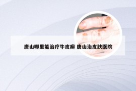 唐山哪里能治疗牛皮癣 唐山治皮肤医院