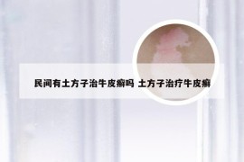 民间有土方子治牛皮癣吗 土方子治疗牛皮癣