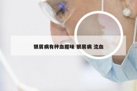 银屑病有种血腥味 银屑病 流血