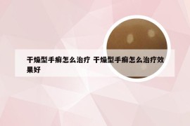 干燥型手癣怎么治疗 干燥型手癣怎么治疗效果好