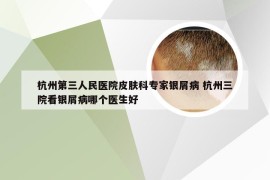 杭州第三人民医院皮肤科专家银屑病 杭州三院看银屑病哪个医生好