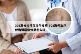 308激光治疗仪治牛皮癣 308激光治疗仪治银屑病效果怎么样
