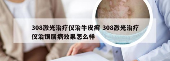 308激光治疗仪治牛皮癣 308激光治疗仪治银屑病效果怎么样