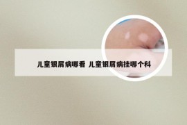 儿童银屑病哪看 儿童银屑病挂哪个科