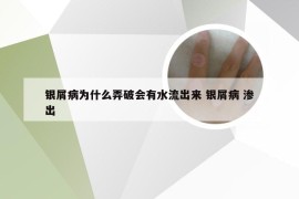 银屑病为什么弄破会有水流出来 银屑病 渗出