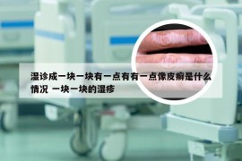 湿诊成一块一块有一点有有一点像皮癣是什么情况 一块一块的湿疹