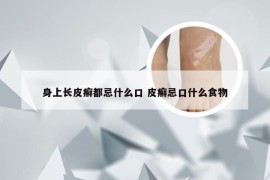 身上长皮癣都忌什么口 皮癣忌口什么食物