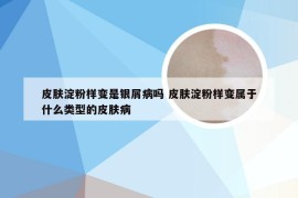 皮肤淀粉样变是银屑病吗 皮肤淀粉样变属于什么类型的皮肤病
