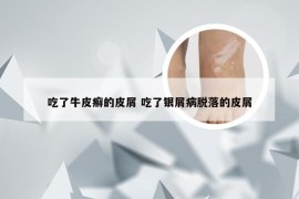 吃了牛皮癣的皮屑 吃了银屑病脱落的皮屑