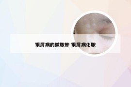 银屑病的微脓肿 银屑病化脓