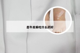 患牛皮癣吃什么药好