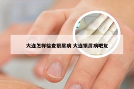 大连怎样检查银屑病 大连银屑病吧友