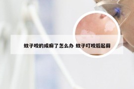 蚊子咬的成癣了怎么办 蚊子叮咬后起藓